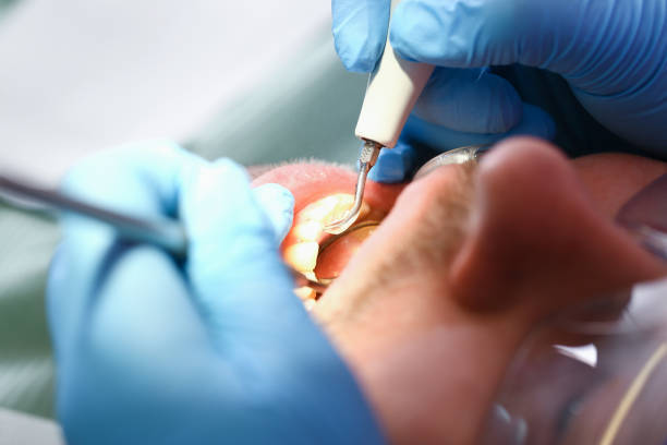 Best Emergency Wisdom Teeth Removal in Summerlin South, NV